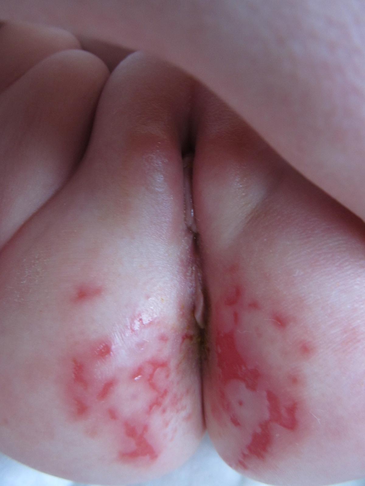сыпь между грудей у женщин фото 119