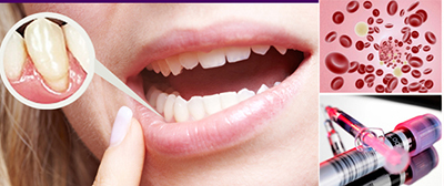 применение плазмы в стоматологии
