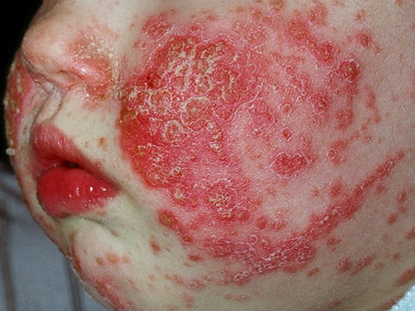 silnyi-atopicheskiy-dermatit.jpg