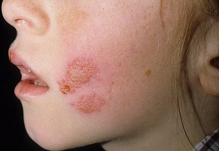 oslojneniya-atopicheskogo-dermatita.jpg