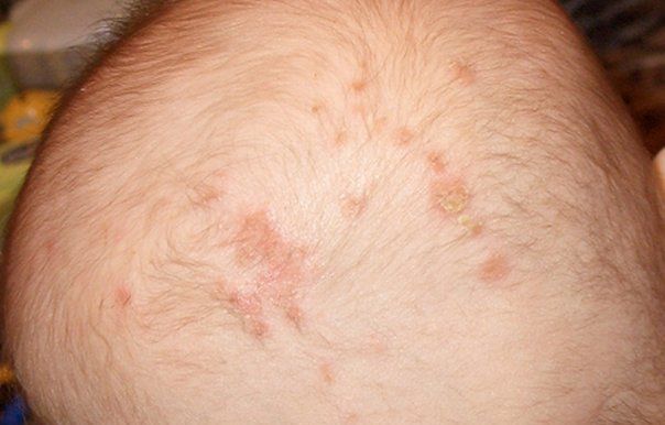 atopich-dermatit.jpg