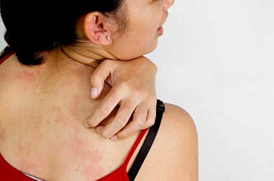 зуд и шелушение кожи при дерматите