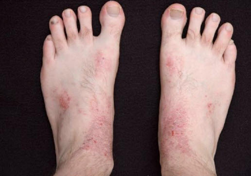 Атопический дерматит на ногах