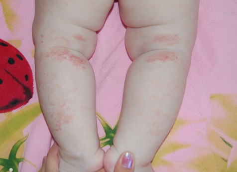 Атопический дерматит на ногах у ребенка