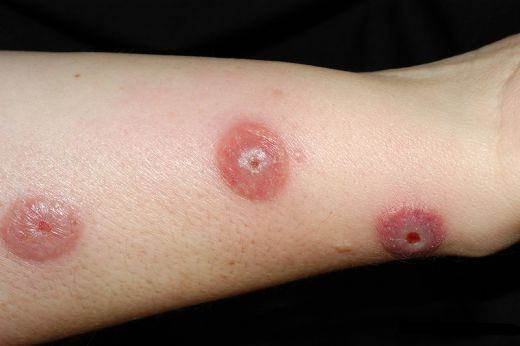 piodermia-oslojneniya-atopicheskogo-dermatita.jpg