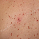Положительный симптом Унны-Дарье - красно-коричневый волдырь в месте механического раздражения кожи