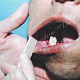 Эрозии на слизистой оболочке полости рта