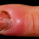 Околоногтевые валики воспалены, прилегающая к ним часть ногтя изменена