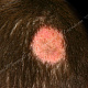 Микроспория, кожа в очаге гиперемирована за счёт сопутствующего аллергического дерматита