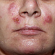 Болезненные узлы на фоне жирной кожи лица