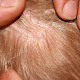 Микроспория волосистой части головы -  шелушение и чехлик из спор вокруг прикорневых зон волос