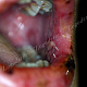 Синдром Стивенса-Джонсона - поражена полость рта