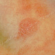 Раздраженный розовый лищай - пятна красного цвета, шелушащиеся по всей поверхности