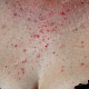 Множественные мелкие полушаровидные узелки и пустулы на фоне гиперемированной кожи