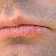Герпетиформно сгруппированные пузырьки на нижней губе