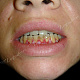 Пузырчатка-изолированное поражение полости рта.Мелкие пузыри по ходу десны нижней челюсти