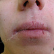 Сухость, воспаление и трещины на красной кайме губ