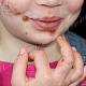 Буллёзное импетиго у ребёнка (поражены лицо и кисть)