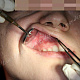 Болезненные эрозии округлой формы на слизистой верхней губы и десны