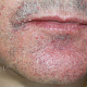Вульгарные бородавки в области угла рта у пациента со стероидным дерматитом лица