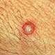 Буллёзное импетиго - напряжённый пузырь на фоне незначительно гиперемированной кожи