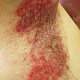Аллергический дерматит на шариковый дезодорант-правая подмышка