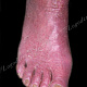 Рубромикоз - поражена стопа и ногти