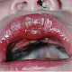 Изъязвление слизистой полости рта у новорождённого с ВПГ