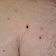 Корки бурого цвета, окружённые венчиком гиперемии