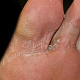 Шелушение на подошвенной поверхности пальцев