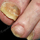 Отслойка ногтевой пластинки большого пальца