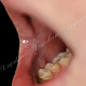 Плоская белесовато-серая папула на слизистой оболочке полости рта
