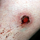 Язва, содержащая остатки корки бурого цвета, окружённая венчиком застойной гиперемии, рядом - атрофический рубец на месте другой эктимы