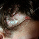 Поражение волосистой части головы при синдроме Литтля-Лассюэра (фолликулярной форме крсаного плоского лишая)
