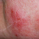 Рецидив заболевания начинается с появления воспалительных пятен на коже