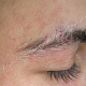 Микроспория, поражена бровь - волосы обламываются на высоте 4-6 мм над уровнем кожи