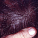 Очаг поредения волос и отрубевидное шелушение