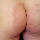 Поверхностная трихофития (микроспория) гладкой кожи