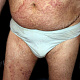 Микоз гладкой кожи на фоне сахарного диабета - распространённые высыпания