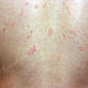 Розовые пятна, распологающиеся вдоль линий растяжения кожи на спине (напоминают ветви ели)