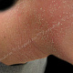 Пластинчатые чешуйки на поверхности лихенифицированной кожи