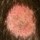 Очаг микроспории на волосистой части головы, видны  волосы, обломанные на высоте 4-6 мм