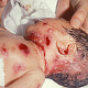 Системная ВПГ-инфекция у недоношенного ребенка. Заражение ВПГ во время родов провоцирует высыпания в области головы и шеи ребенка