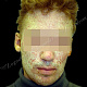 Импетиго лица-желтоватые корки, распространившиеся по коже лица менее чем за сутки