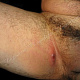 Гиперемированная кожа в области внутренней поверхности бедра указывает на провоцирующую роль трения в развитии заболевания