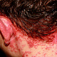 Аллергический дерматит на краску для волос