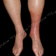 Односторонний фотоаллергический дерматит(на ноге, которую мазал бепантеном)