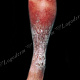 Четкие крупнофестончатые очертания, окружённые венчиком застойной гиперемии, слоистые чешуйко-корки