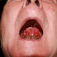 Изолированное поражение полости рта