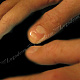 Изменения ногтевой пластинки - неровная и отполированная поверхность